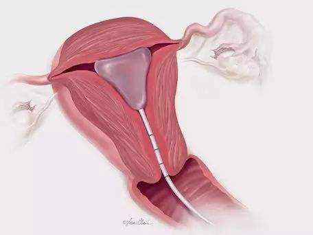 三代试管冷冻胎胚多少时间